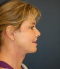 Feel Beautiful - Neck Lift San Diego 38 - After Photo